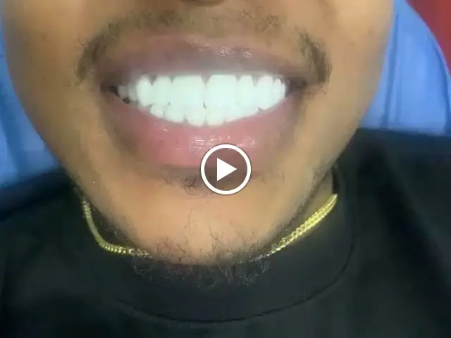 Bright smile after professional teeth whitening