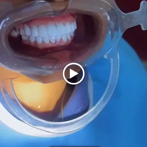Smile after tooth colored veneers fitting in Ota