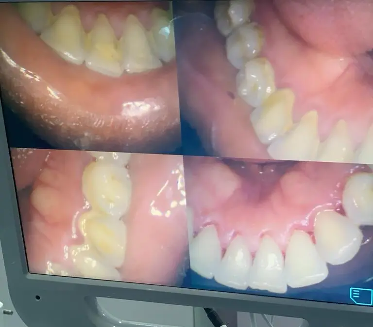 Dental Implants at Royal Aesthetics Dental Clinic in Ota
