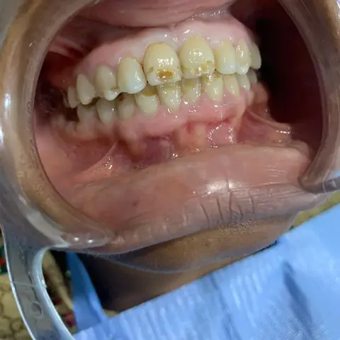 Stained teeth before scaling and polishing