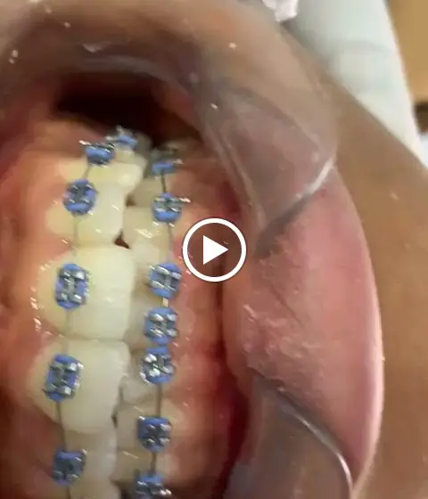 Aligners care in Ota, Ogun State