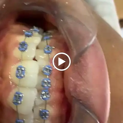 Orthodontic braces fitted at Royal Aesthetics Dental Clinic